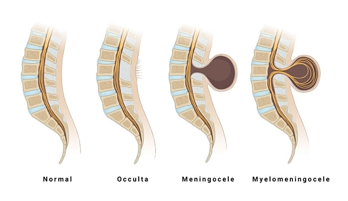 انواع بیماری اسپینا بیفیدا