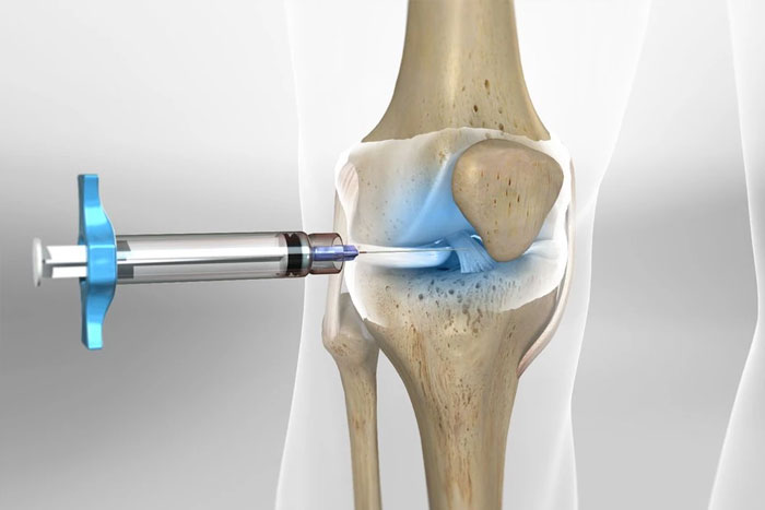 انواع ژل تزریقی به زانو