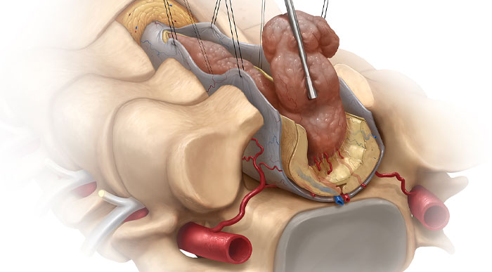 جراحی تومور نخاعی