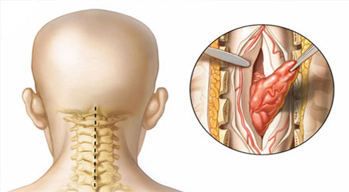 آیا تومور نخاعی منجر به مرگ می‌ شود؟