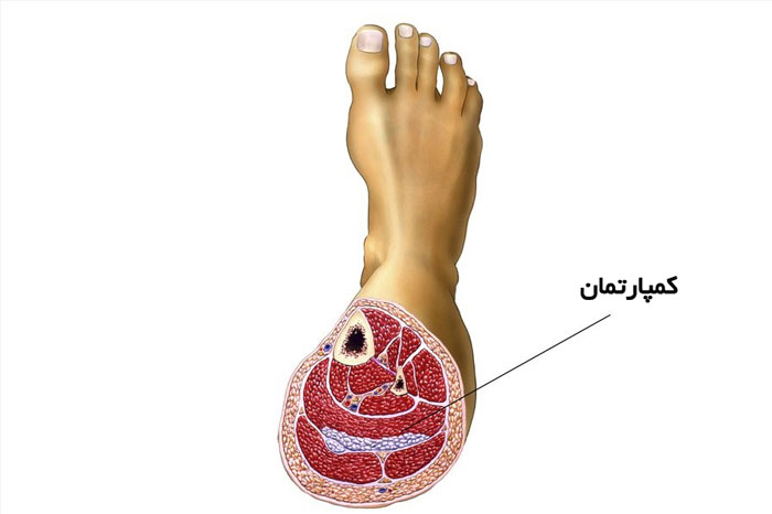 سندروم کمپارتمان چیست؟