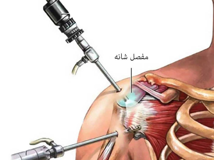 درمان سریع شانه یخ زده