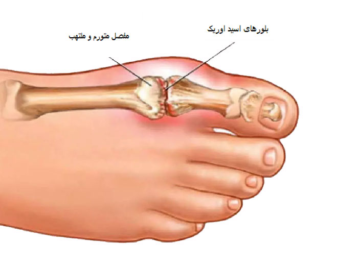نقرس چیست و راه درمان آن
