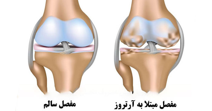 درمان قطعی آرتروز