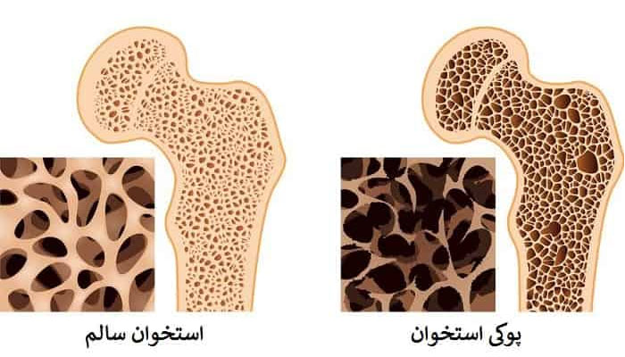  برای پوکی استخوان چی بخوریم