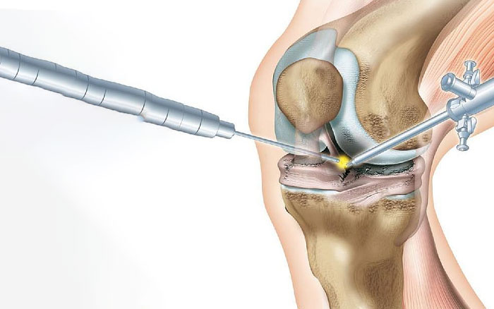  آرتروسکوپی زانو