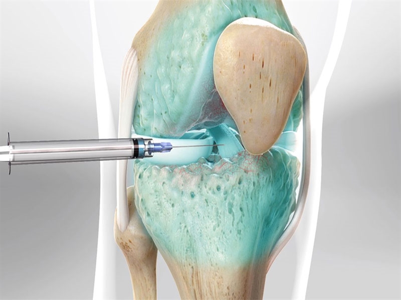 تزریق ژل به زانو: راهکاری موثر برای تسکین درد