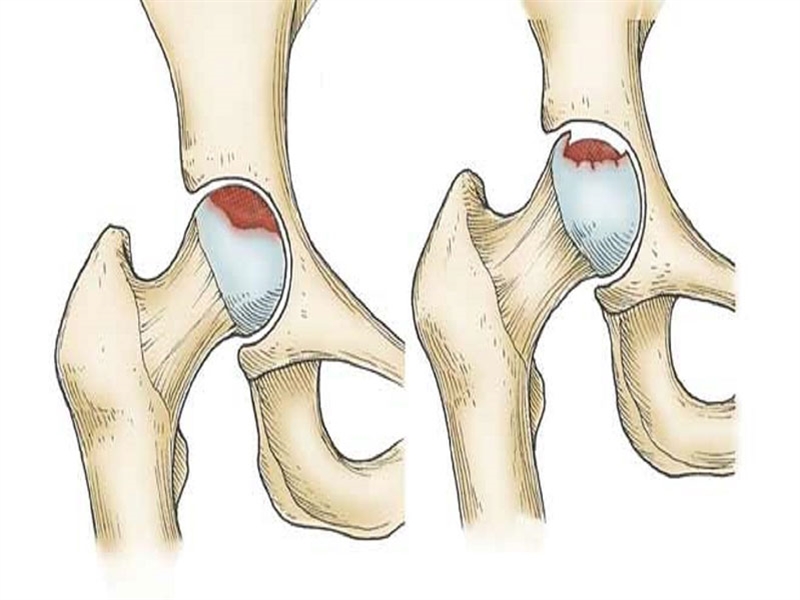 سیاه شدن سر استخوان ران: راهنمای کامل برای بیماران