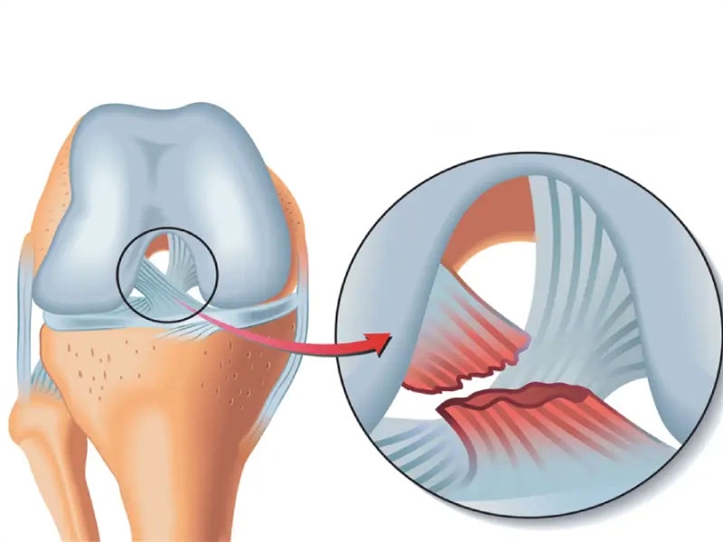 پارگی رباط صلیبی و آشنایی با نحوه تشخیص و درمان به موقع!