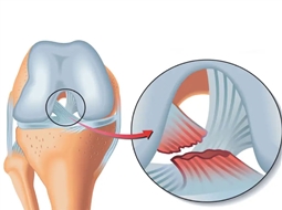 پارگی رباط صلیبی و آشنایی با نحوه تشخیص و درمان به موقع!
