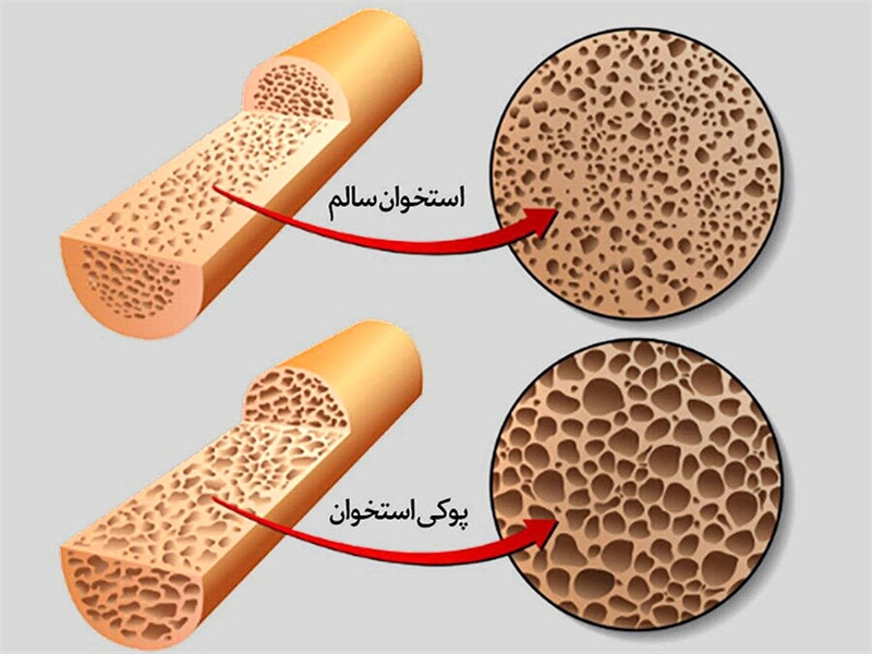 علت، علائم، راه های پیشگیری و درمان پوکی استخوان