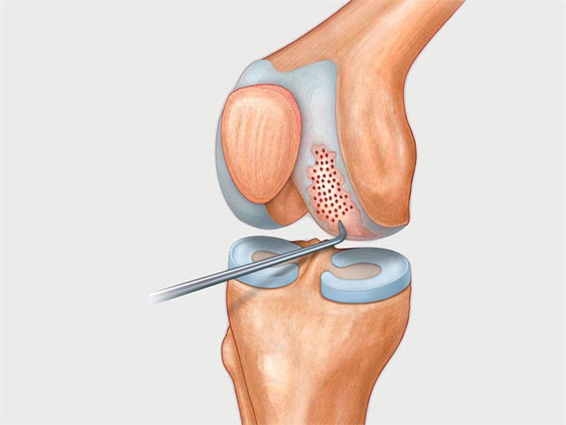 همه چیز درباره عمل جراحی میکروفرکچر زانو