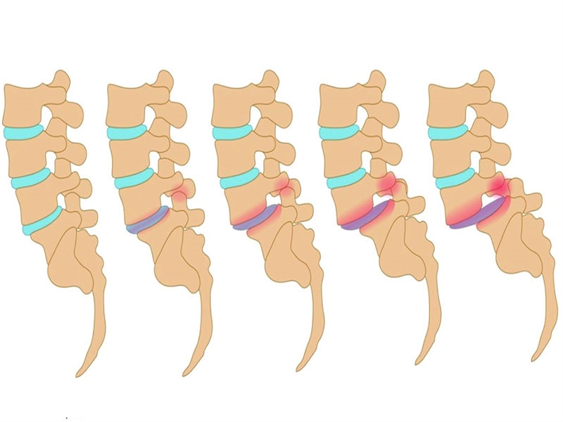 سرخوردگی مهره کمر چیست و چه عوارضی دارد؟