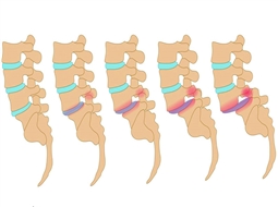 سرخوردگی مهره کمر چیست و چه عوارضی دارد؟