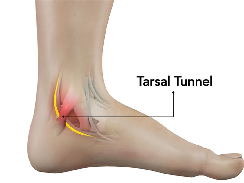 سندروم تونل تارسال؛ بی حسی و سوزن سوزن شدن پا