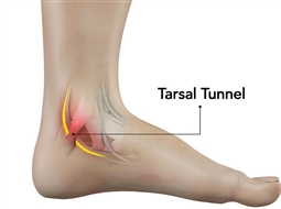 سندروم تونل تارسال؛ بی حسی و سوزن سوزن شدن پا